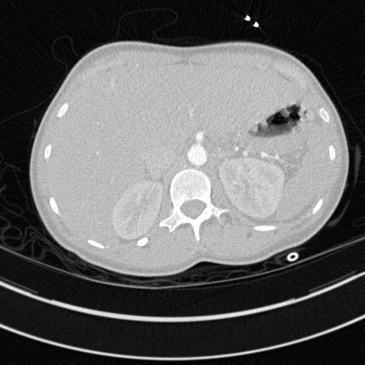 Bronchogenic cyst (Radiopaedia 77801-90071 Axial lung window 88).jpg