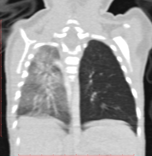 Bronchogenic cyst (Radiopaedia 78599-91409 Coronal lung window 159).jpg