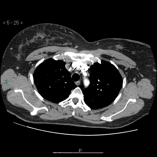 Bronchogenic cyst - posterior mediastinal (Radiopaedia 43885-47364 A 15).jpg