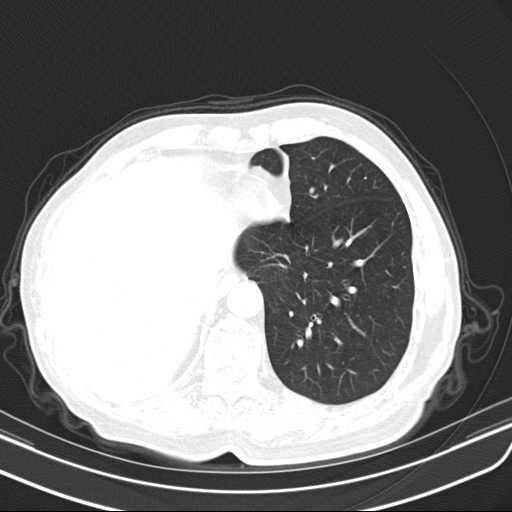 Bronchopleural fistula - postoperative complication (Radiopaedia 21020-20947 Axial lung window 44).jpg