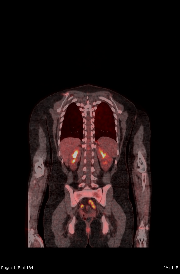 Brown fat uptake (FDG PET-CT) (Radiopaedia 77392-89513 Fused coronal 73).jpg