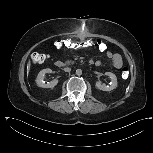 File:Buried bumper syndrome - gastrostomy tube (Radiopaedia 63843-72577 Axial Inject 43).jpg