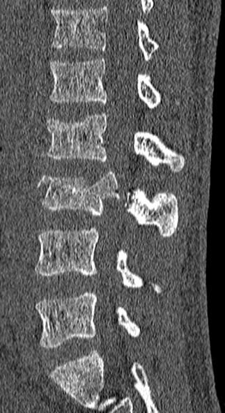 Burst fracture (Radiopaedia 53373-59357 Sagittal bone window 31).jpg