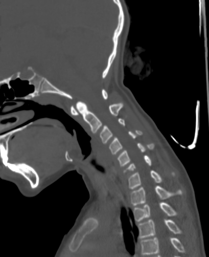 File:Butterfly vertebra (Radiopaedia 77903-90209 Sagittal bone window 39).jpg