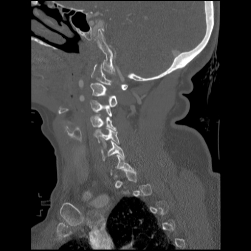 File:C1 anterior arch (plough) fracture - type 1 (Radiopaedia 76181-87720 Sagittal bone window 70).jpg