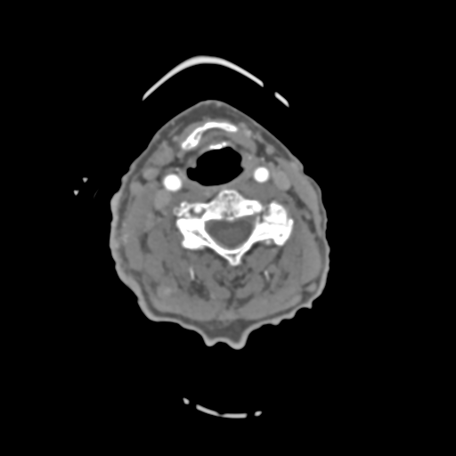 C2 fracture with vertebral artery dissection (Radiopaedia 37378-39200 A 130).png