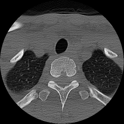 File:C5 facet fracture (Radiopaedia 58374-65499 Axial bone window 93).jpg