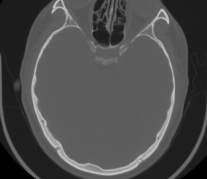 C7 laminar fracture and Klippel-Feil syndrome (Radiopaedia 86710-102850 Axial bone window 3).jpg