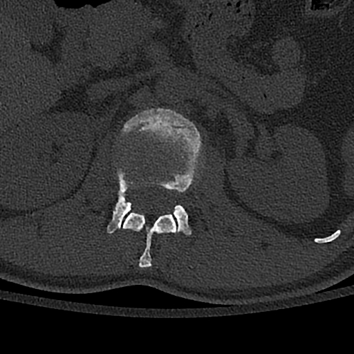 Calcaneal fractures with associated L2 burst fracture (Radiopaedia 71671-82493 Axial bone window 24).jpg