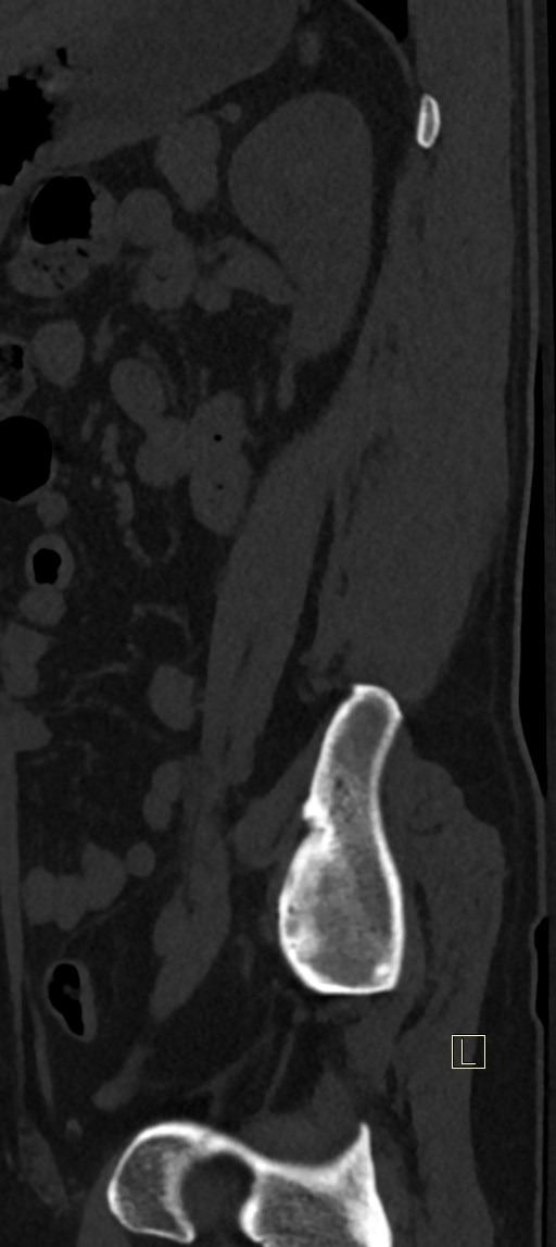 Calcaneal fractures with associated L2 burst fracture (Radiopaedia 71671-82493 Sagittal bone window 1).jpg