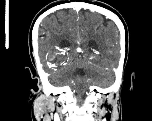 Calcified cerebral hydatid cyst (Radiopaedia 65603-74717 C 50).jpg