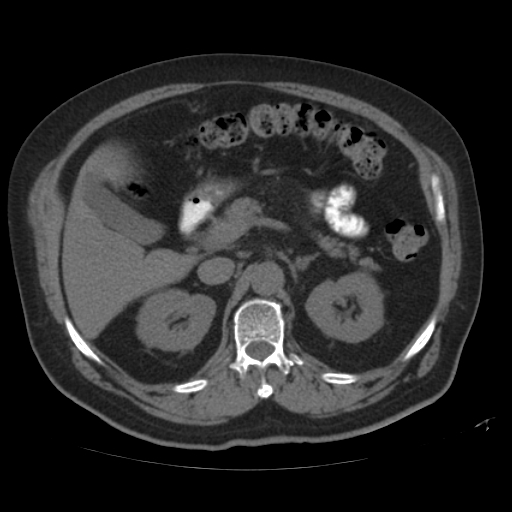 File:Calcified hepatic hydatid cyst (Radiopaedia 18907-18853 Axial non-contrast 20).jpg