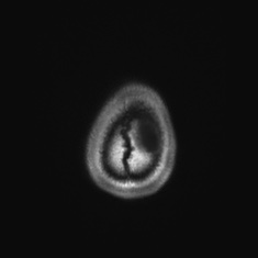 Callosal dysgenesis with interhemispheric cyst (Radiopaedia 53355-59335 Axial T1 155).jpg