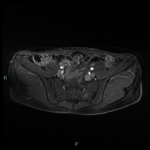File:Canal of Nuck cyst (Radiopaedia 55074-61448 Axial T1 C+ fat sat 10).jpg