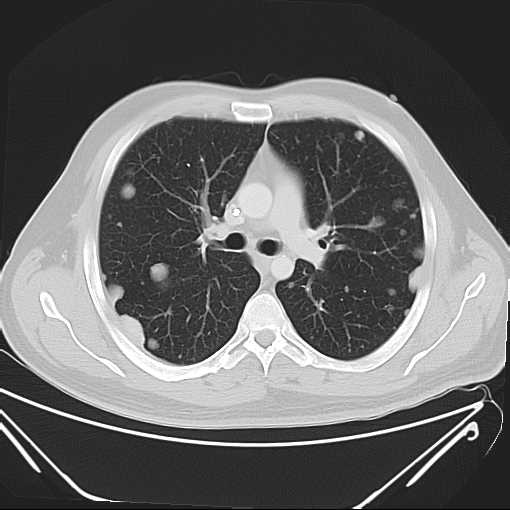 File:Cannonball pulmonary metastases (Radiopaedia 67684-77101 Axial lung window 10).jpg