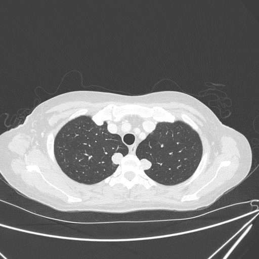 Canonball lung metastasis (Radiopaedia 77634-89837 Axial lung window 36).jpg