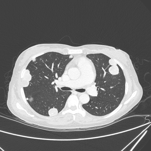 Canonball lung metastasis (Radiopaedia 77634-89837 Axial lung window 78).jpg