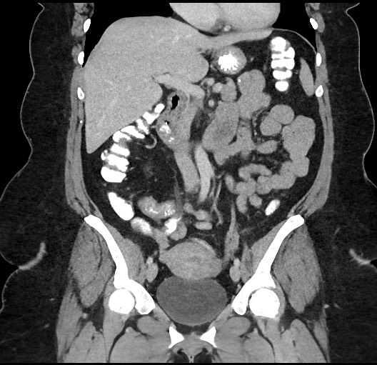 File:Carcinoid tumor - terminal ileum (Radiopaedia 60931-68739 B 39).jpg