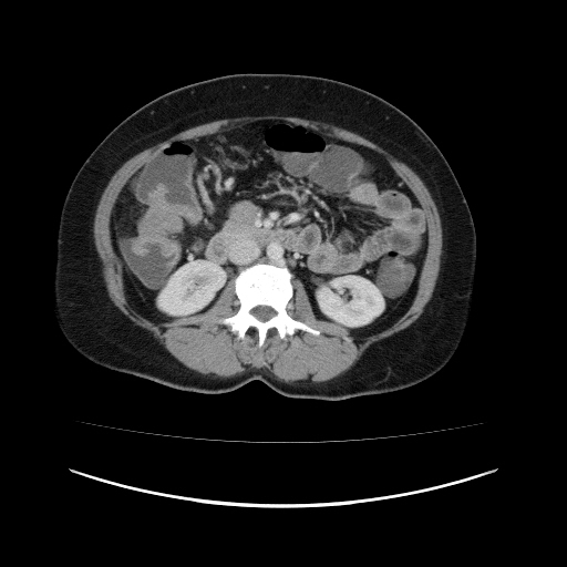 Carcinoma colon - hepatic flexure (Radiopaedia 19461-19493 A 57).jpg