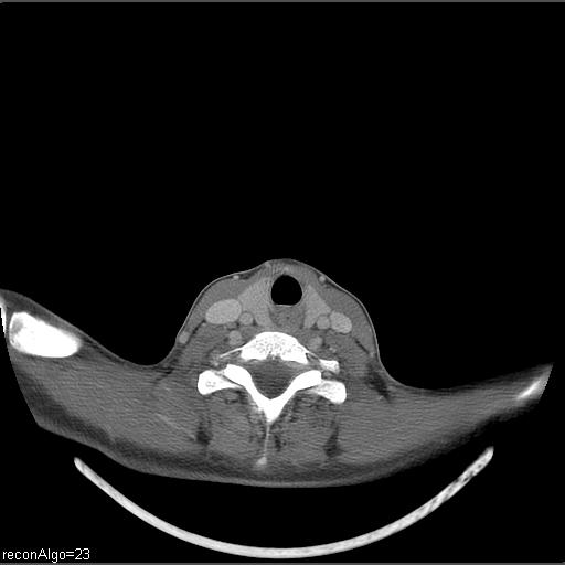 Carcinoma of the maxillary antrum (Radiopaedia 53805-59888 Axial C+ delayed 10).jpg