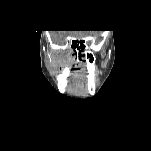 File:Carcinoma of the maxillary antrum (Radiopaedia 53805-59888 Coronal C+ delayed 52).jpg