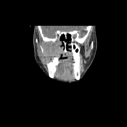 Carcinoma of the maxillary antrum (Radiopaedia 53805-59888 Coronal C+ delayed 53).jpg