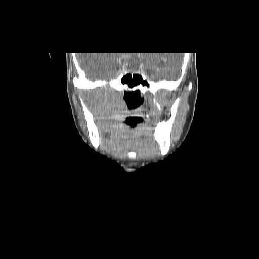 Carcinoma of the maxillary antrum (Radiopaedia 53805-59888 Coronal C+ delayed 69).jpg
