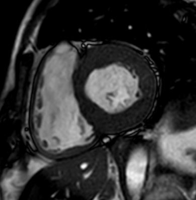 Cardiac amyloidosis - ATTR wild-type (Radiopaedia 74412-85296 short axis cine SSFP 148).jpg