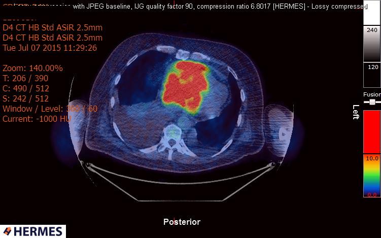 File:Cardiac lymphoma (Radiopaedia 38690-40871 Integrated PET-CT 17).jpg