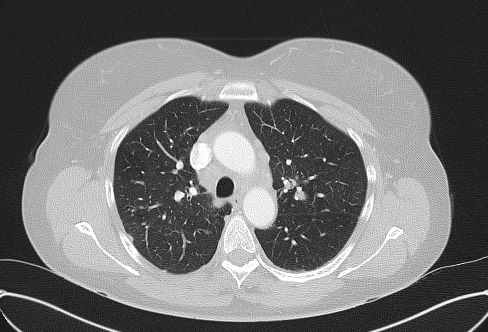 File:Cardiac sarcoidosis (Radiopaedia 74548-85534 Axial lung window 27).jpg