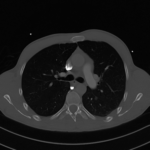 Cardiac tumor - undifferentiated pleomorphic sarcoma (Radiopaedia 45844-50134 Axial bone window 27).png