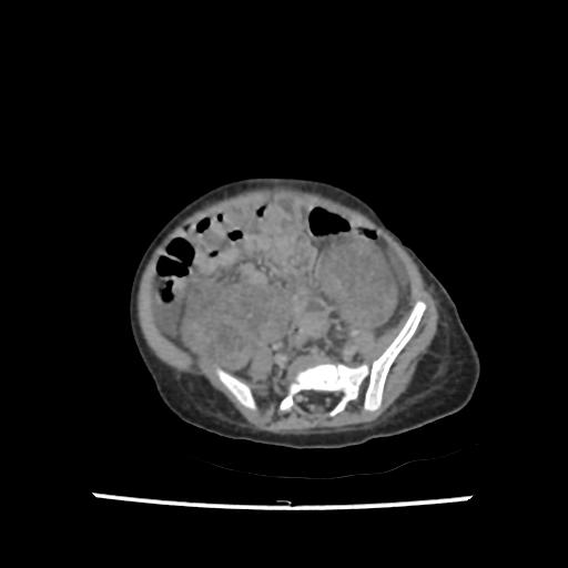 Caroli disease with autosomal recessive polycystic kidney disease (ARPKD) (Radiopaedia 89651-106703 B 170).jpg