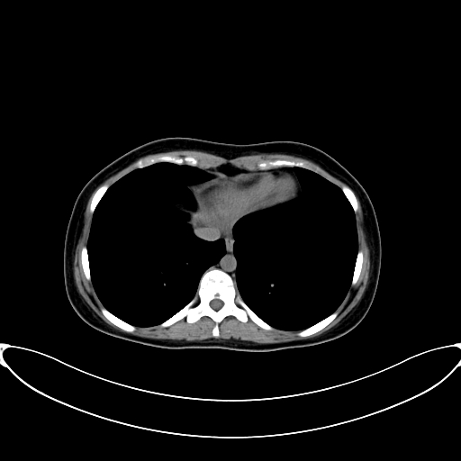 Caroli disease with medullary sponge kidney (Radiopaedia 82622-96804 Axial non-contrast 10).jpg
