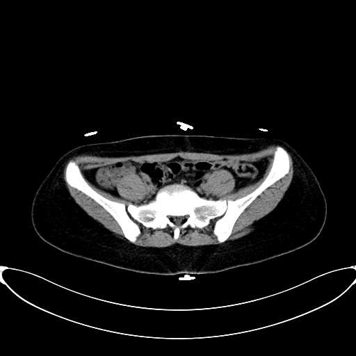 Caroli disease with medullary sponge kidney (Radiopaedia 82622-96804 Axial non-contrast 55).jpg