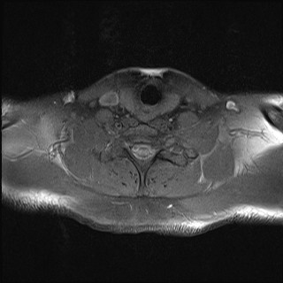 File:Carotid artery dissection (Radiopaedia 28441-28689 Axial T1 fat sat 10).jpg