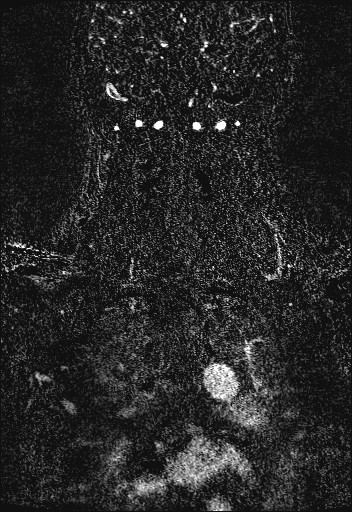 Carotid artery dissection (Radiopaedia 28441-28689 Coronal MRA 80).jpg