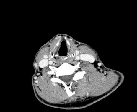 Carotid body tumor (Radiopaedia 61750-69757 Axial Post contrast 78).jpg