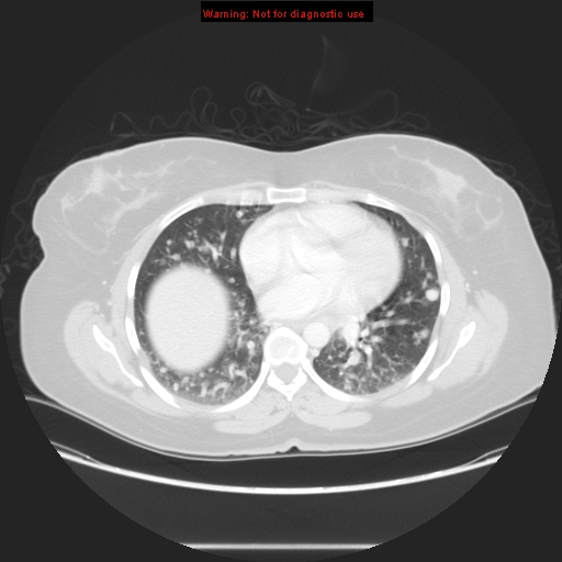 Carotid body tumor with lung metastases (Radiopaedia 9301-48390 Axial lung window 42).jpg