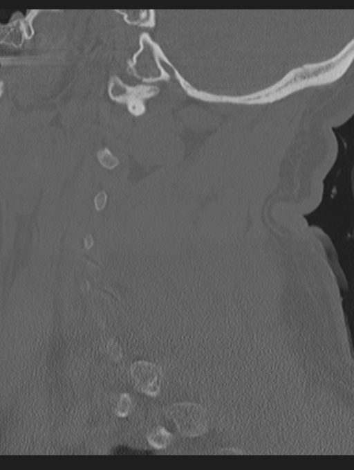 Cavernoma of cervical cord (Radiopaedia 50838-56346 Sagittal bone window 22).png