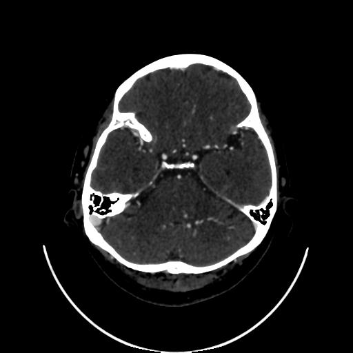 Cavernoma with developmental venous anomaly (Radiopaedia 22470-22506 C 40).jpg