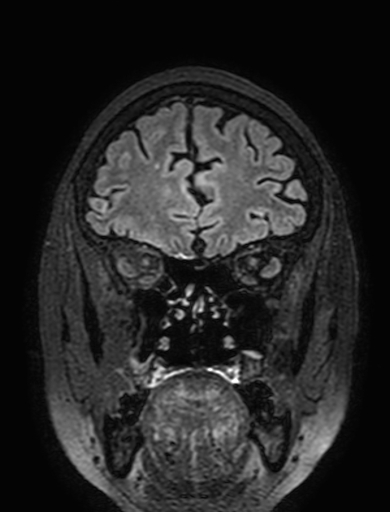Cavernous hemangioma of the cerebellar falx (Radiopaedia 73025-83724 Coronal FLAIR 74).jpg