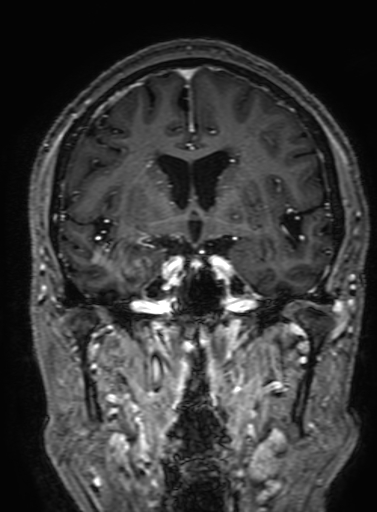 Cavernous hemangioma of the cerebellar falx (Radiopaedia 73025-83724 Coronal T1 C+ 164).jpg