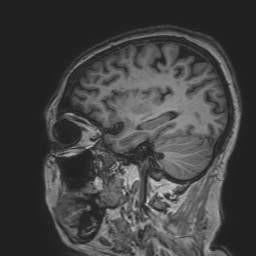 File:Cavernous hemangioma of the cerebellar falx (Radiopaedia 73025-83724 Sagittal T1 60).jpg