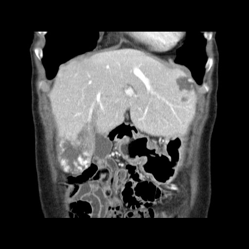 Cavernous hepatic hemangioma (Radiopaedia 75441-86667 C 35).jpg