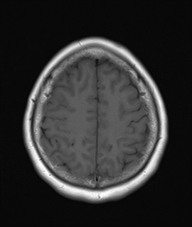 File:Cavernous sinus meningioma (Radiopaedia 63682-72367 Axial T1 18).jpg