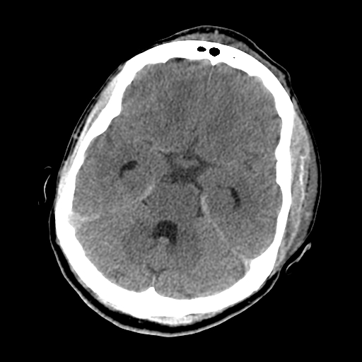 File:Cavernous sinus thrombosis (Radiopaedia 10619-11078 Axial non-contrast 16).jpg