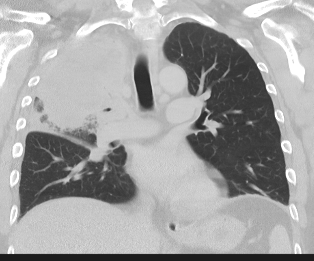 Cavitating pneumonia (Radiopaedia 45998-50329 Coronal lung window 27).png