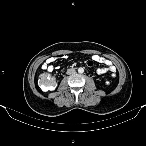 Cecal adenocarcinoma (Radiopaedia 85324-100916 B 50).jpg