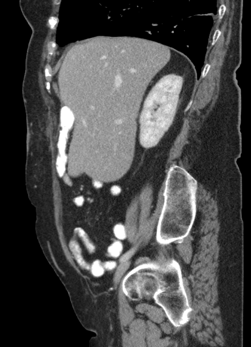 Cecal adenocarcinoma - surgical scar recurrence (Radiopaedia 79988-93264 D 46).jpg