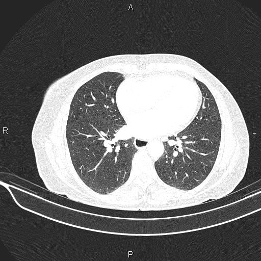 Cecal cancer (Radiopaedia 85610-101358 Axial lung window 41).jpg